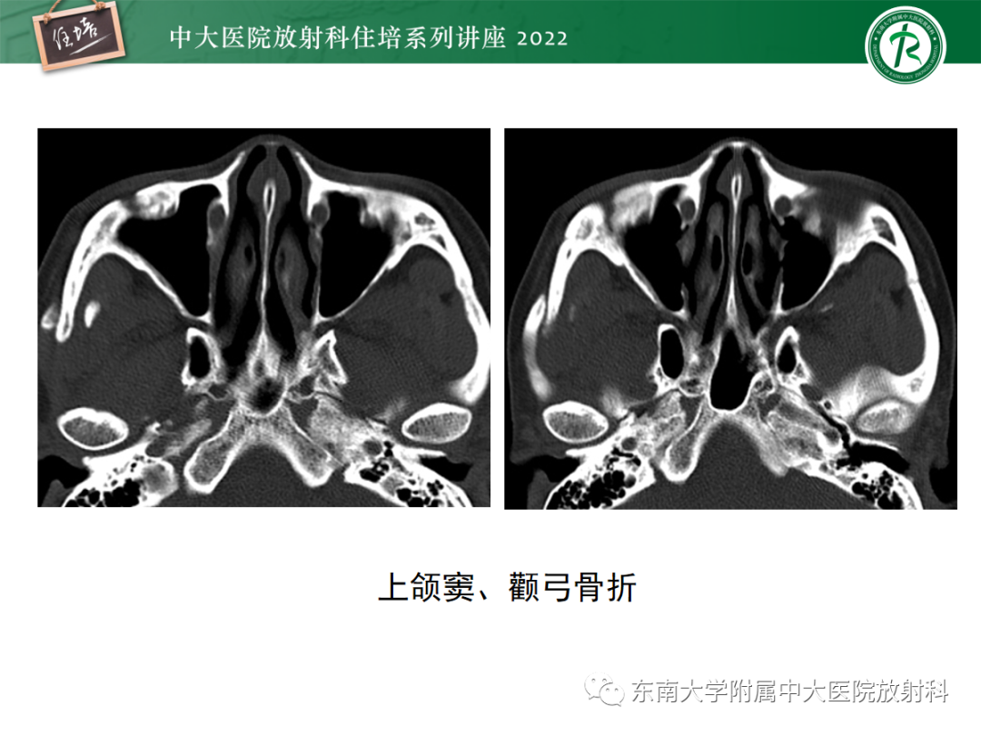 影像PPT - 【PPT】颌面部外伤的影像评估-25