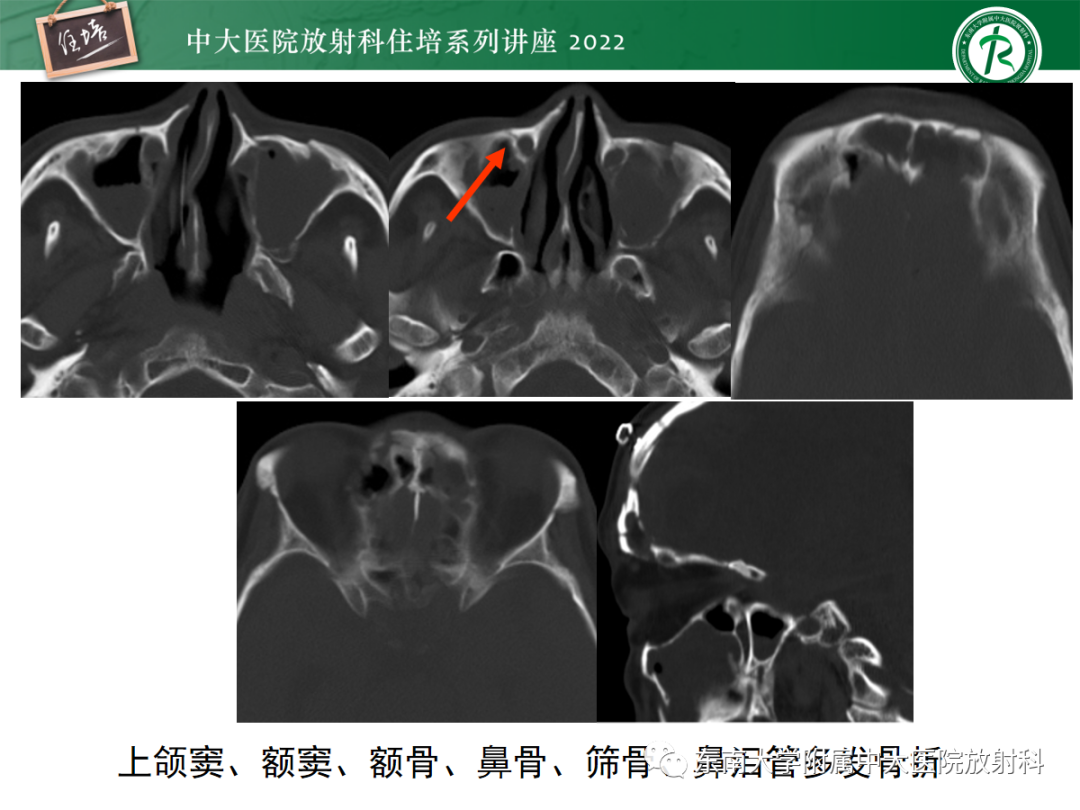 影像PPT - 【PPT】颌面部外伤的影像评估-26
