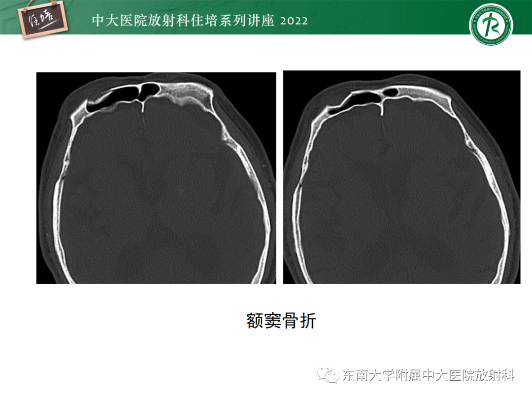 影像PPT - 【PPT】颌面部外伤的影像评估-28