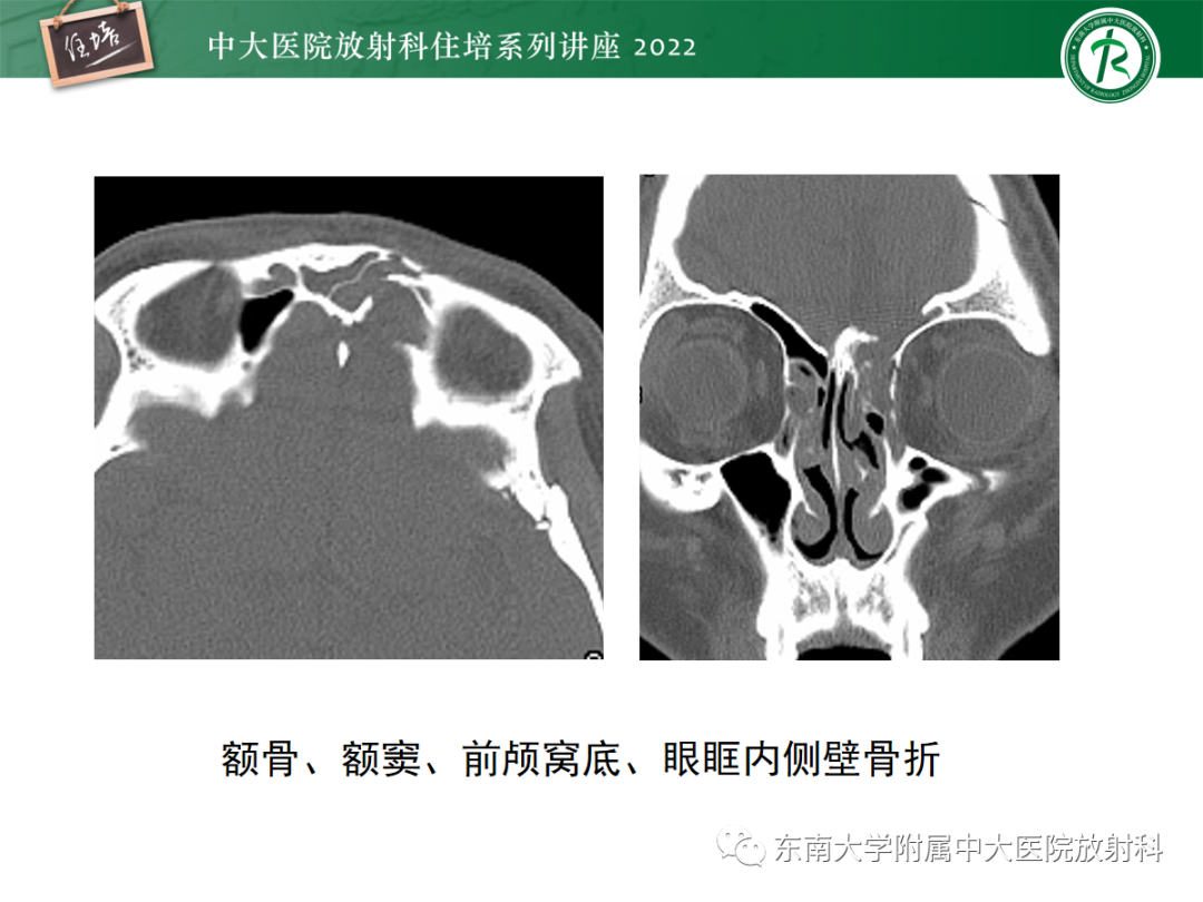 影像PPT - 【PPT】颌面部外伤的影像评估-29