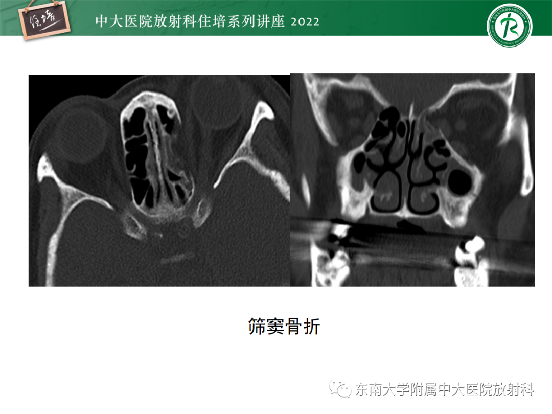 影像PPT - 【PPT】颌面部外伤的影像评估-31