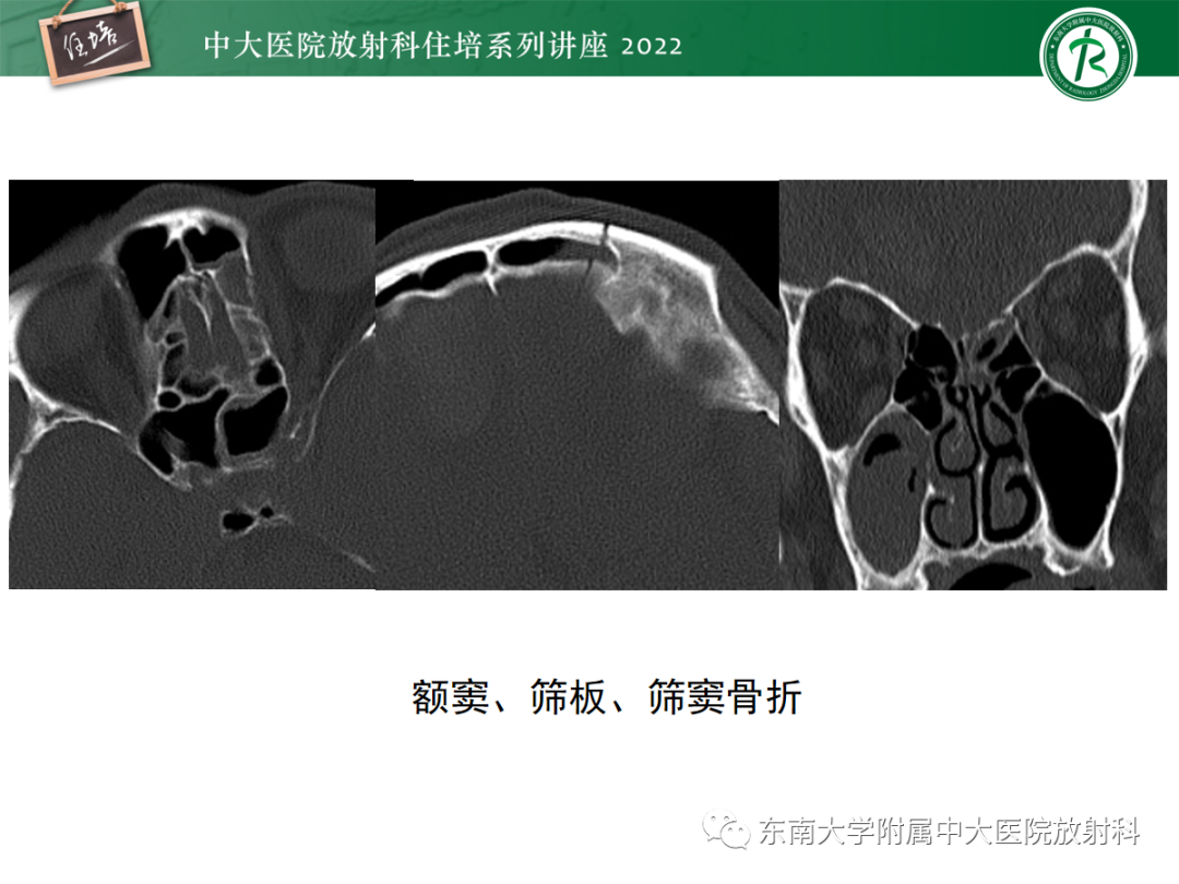 影像PPT - 【PPT】颌面部外伤的影像评估-32