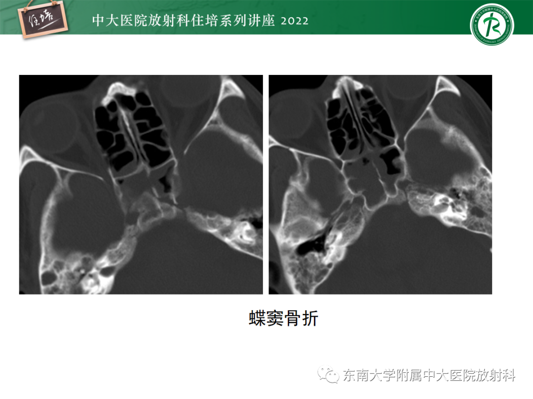 影像PPT - 【PPT】颌面部外伤的影像评估-34