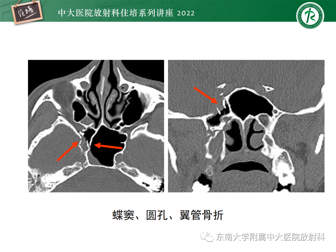 影像PPT - 【PPT】颌面部外伤的影像评估-35