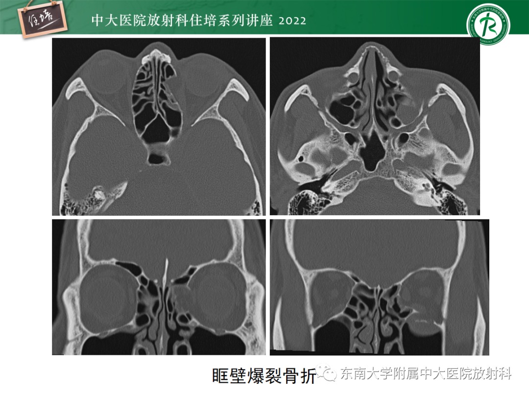 影像PPT - 【PPT】颌面部外伤的影像评估-38