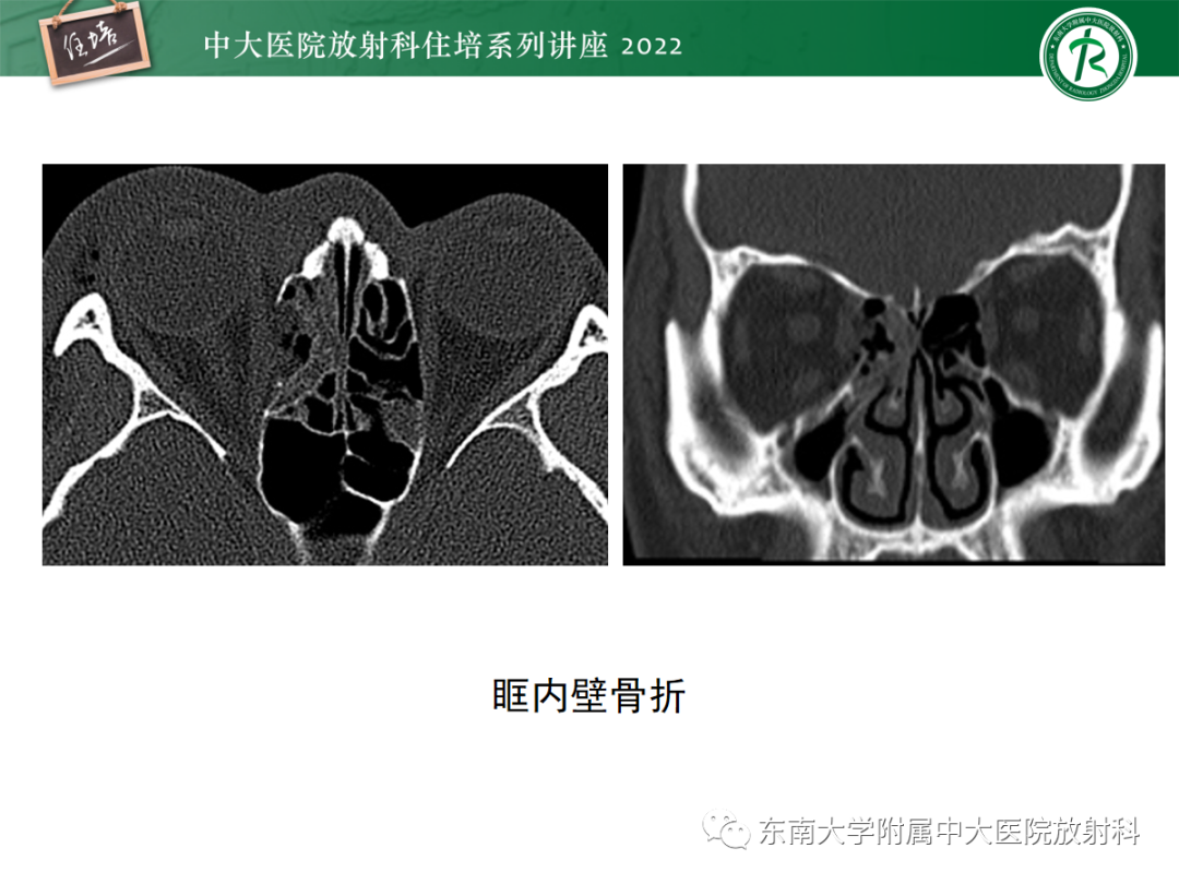 影像PPT - 【PPT】颌面部外伤的影像评估-39