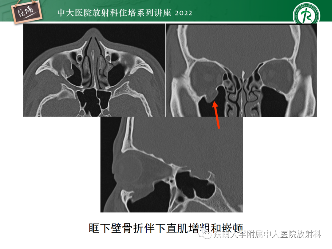 影像PPT - 【PPT】颌面部外伤的影像评估-40