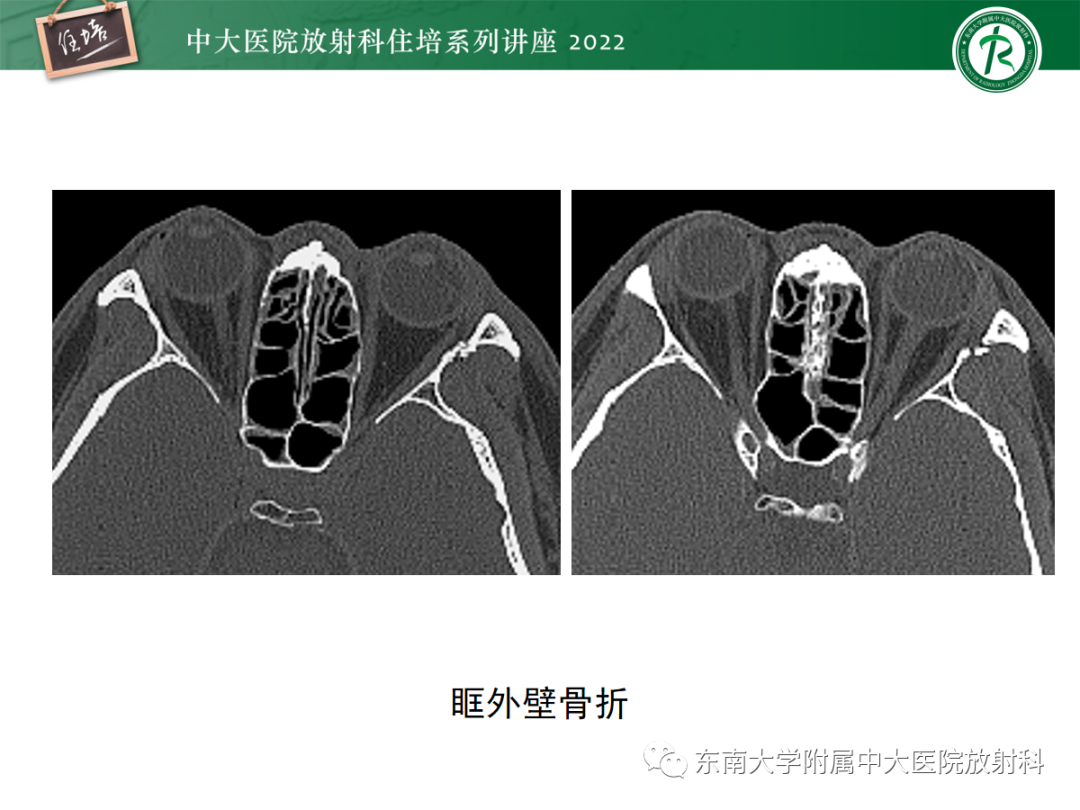 影像PPT - 【PPT】颌面部外伤的影像评估-41
