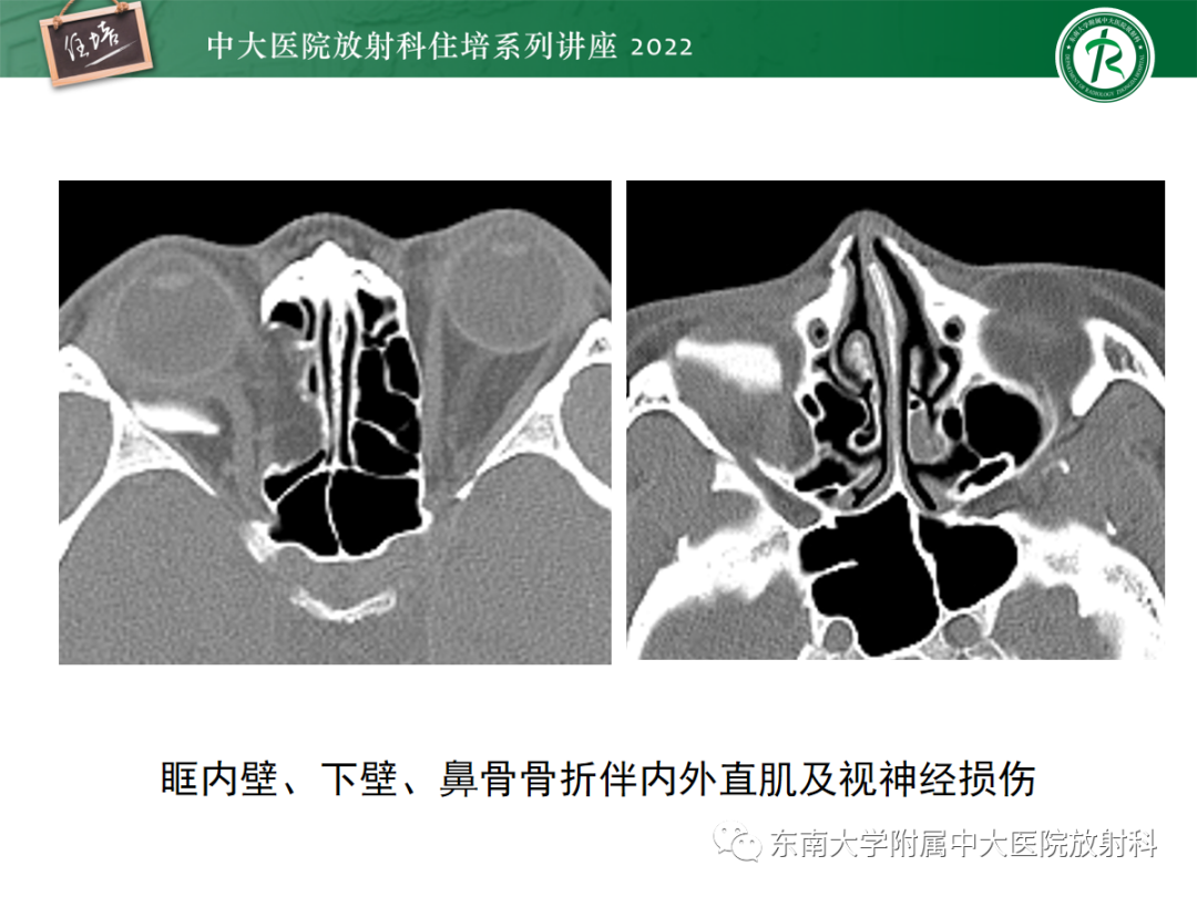 影像PPT - 【PPT】颌面部外伤的影像评估-42