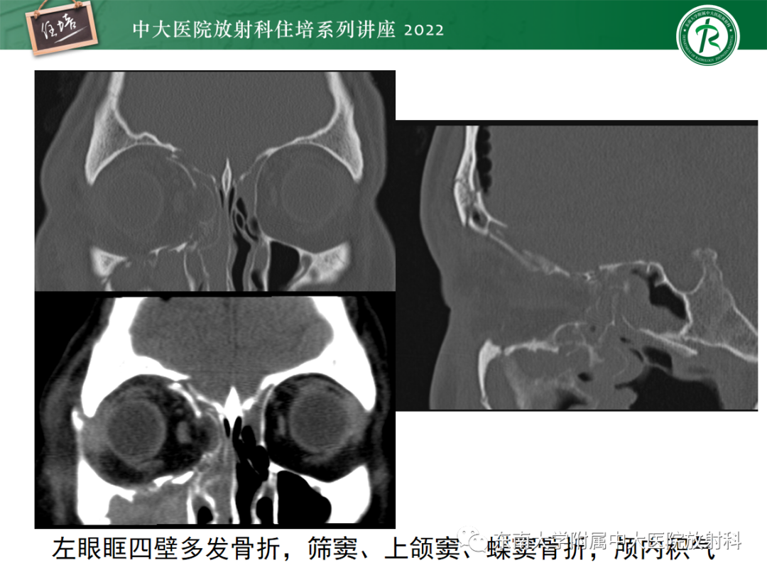 影像PPT - 【PPT】颌面部外伤的影像评估-43