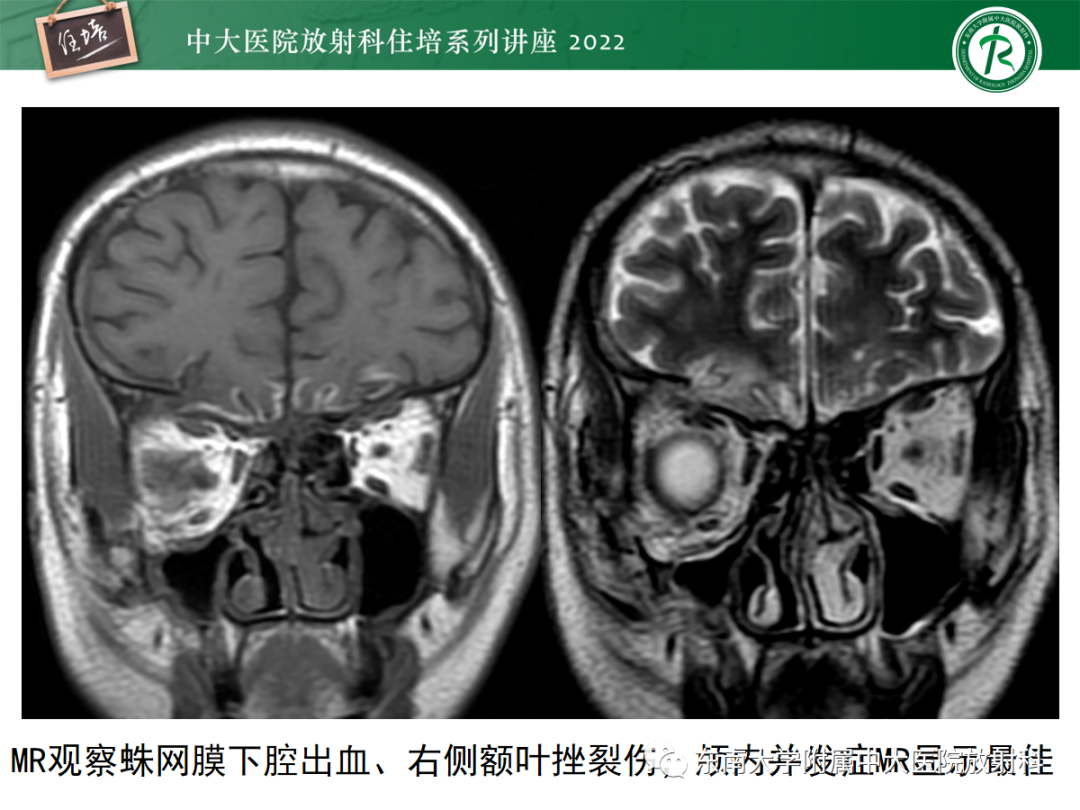 影像PPT - 【PPT】颌面部外伤的影像评估-44