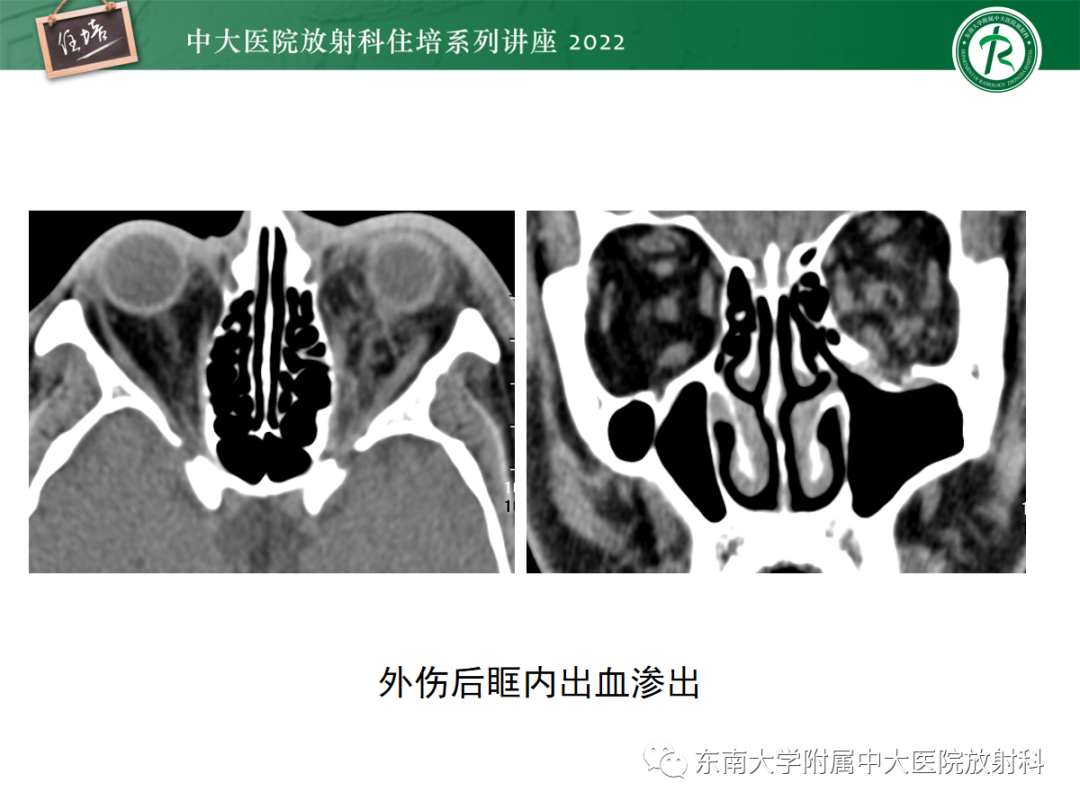 影像PPT - 【PPT】颌面部外伤的影像评估-46