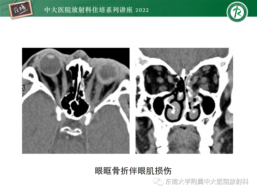 影像PPT - 【PPT】颌面部外伤的影像评估-45