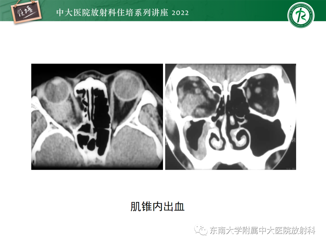 影像PPT - 【PPT】颌面部外伤的影像评估-47