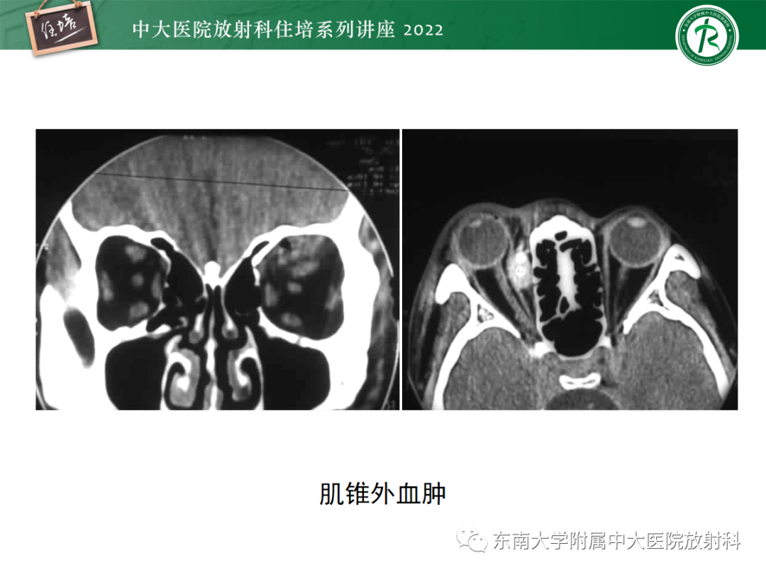 影像PPT - 【PPT】颌面部外伤的影像评估-48