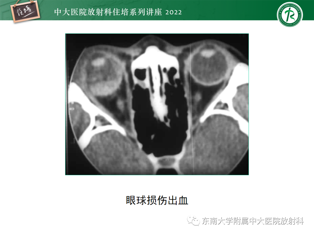 影像PPT - 【PPT】颌面部外伤的影像评估-49