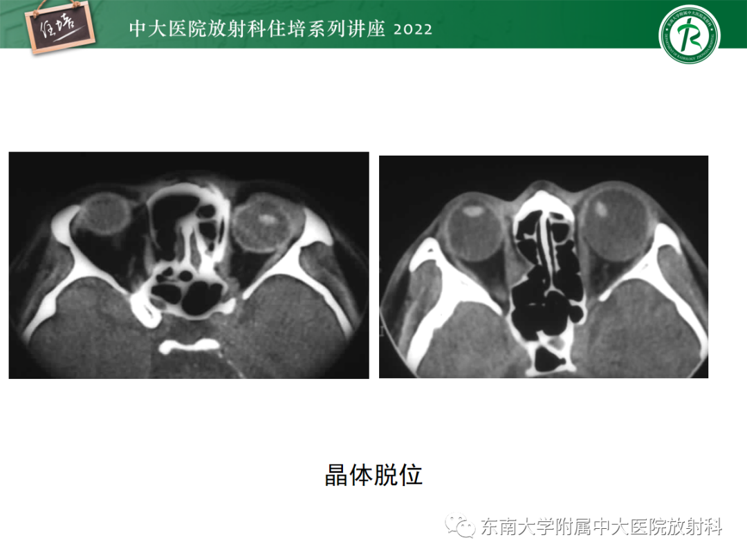 影像PPT - 【PPT】颌面部外伤的影像评估-50