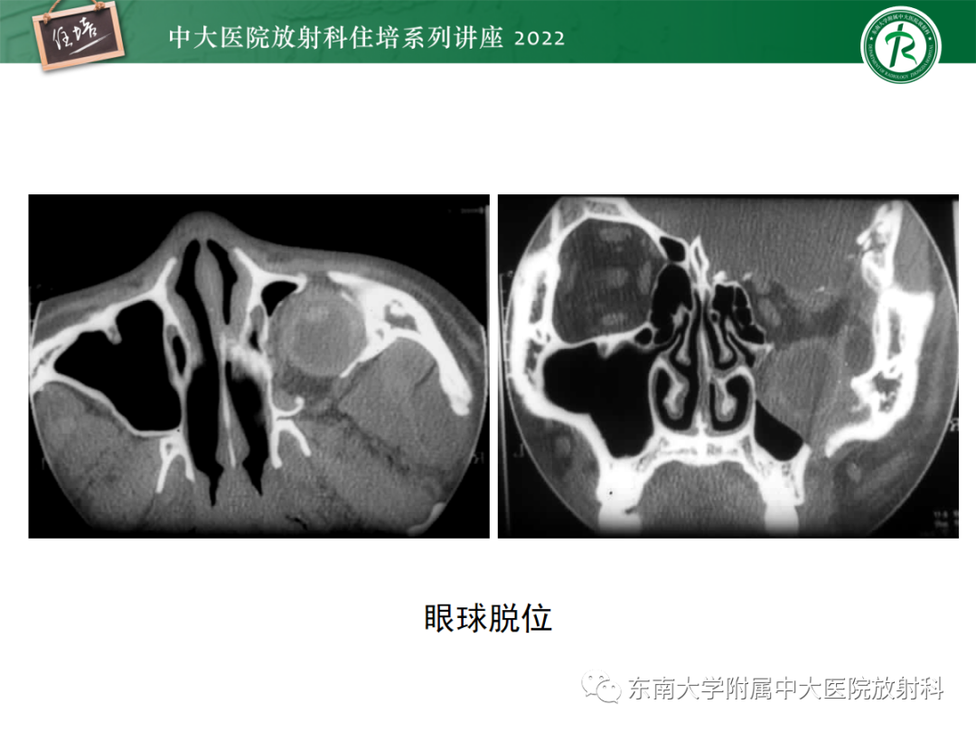 影像PPT - 【PPT】颌面部外伤的影像评估-51