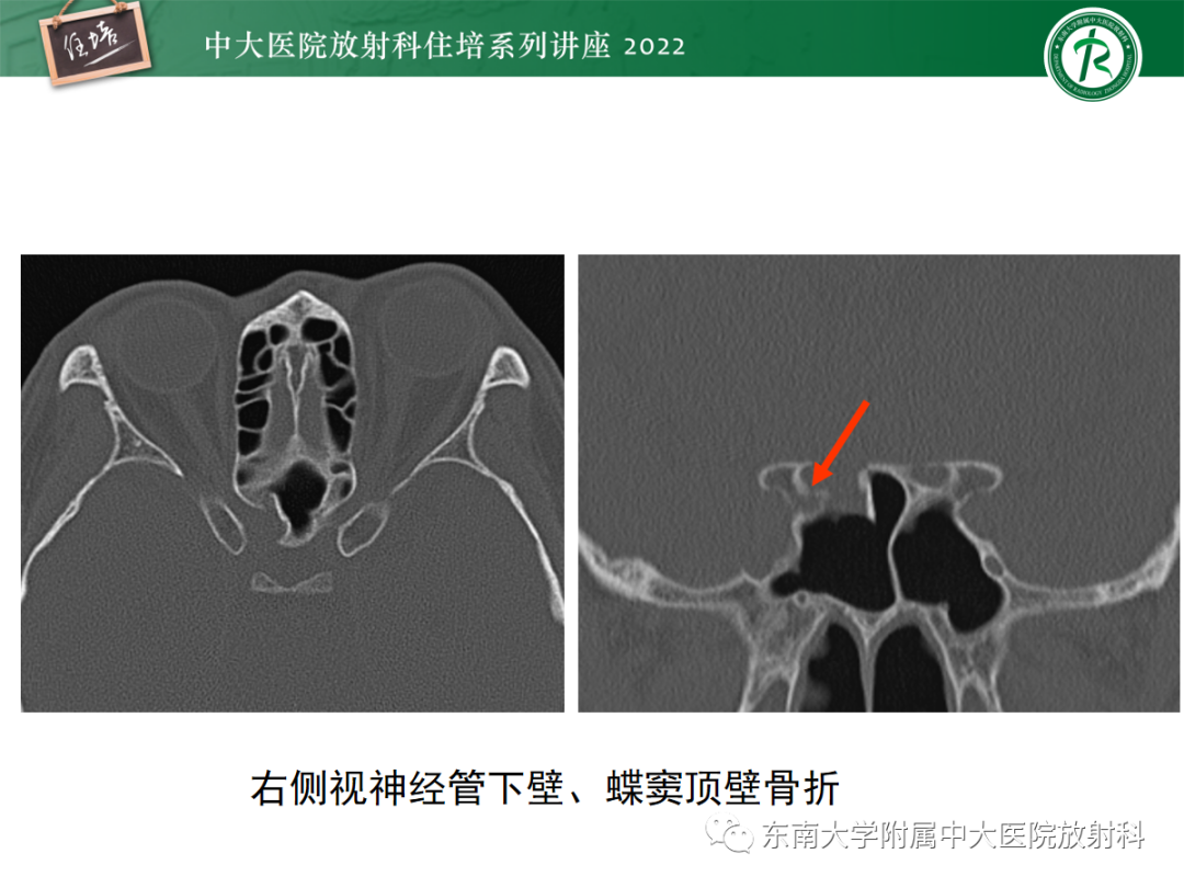 影像PPT - 【PPT】颌面部外伤的影像评估-54