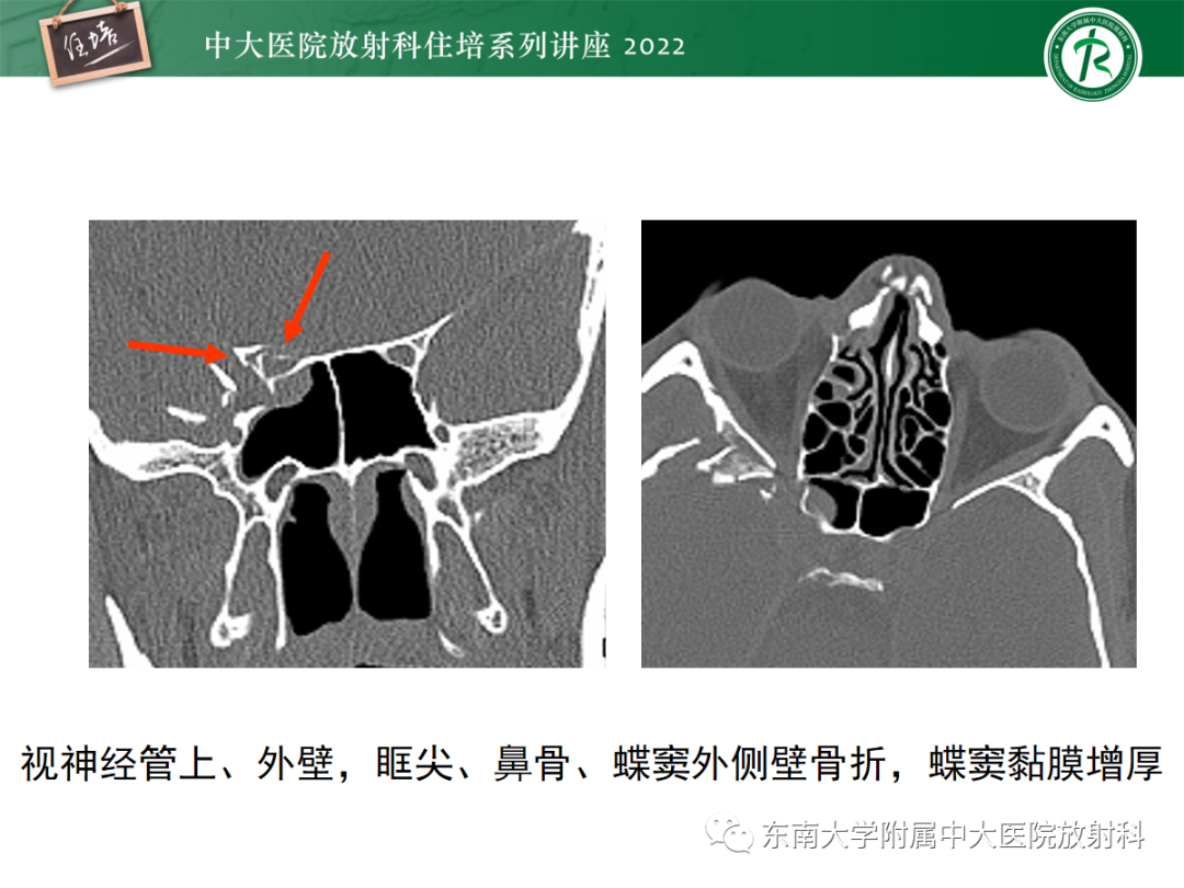 影像PPT - 【PPT】颌面部外伤的影像评估-55