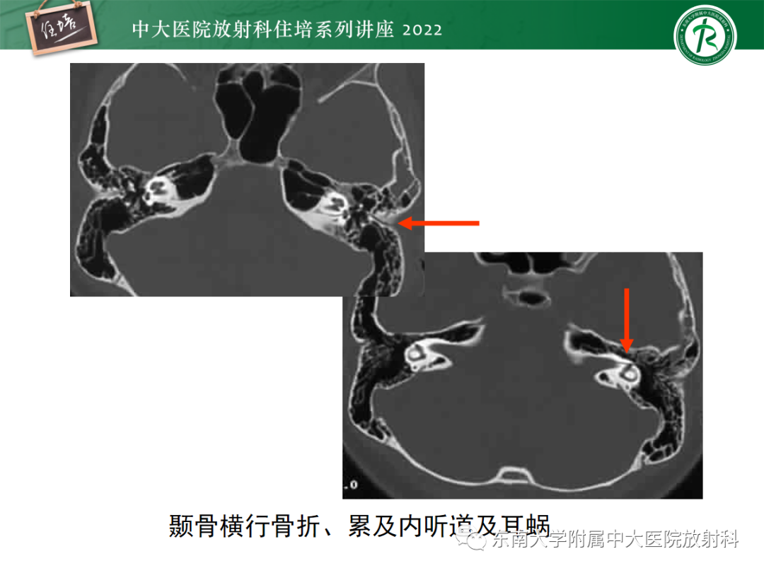影像PPT - 【PPT】颌面部外伤的影像评估-60