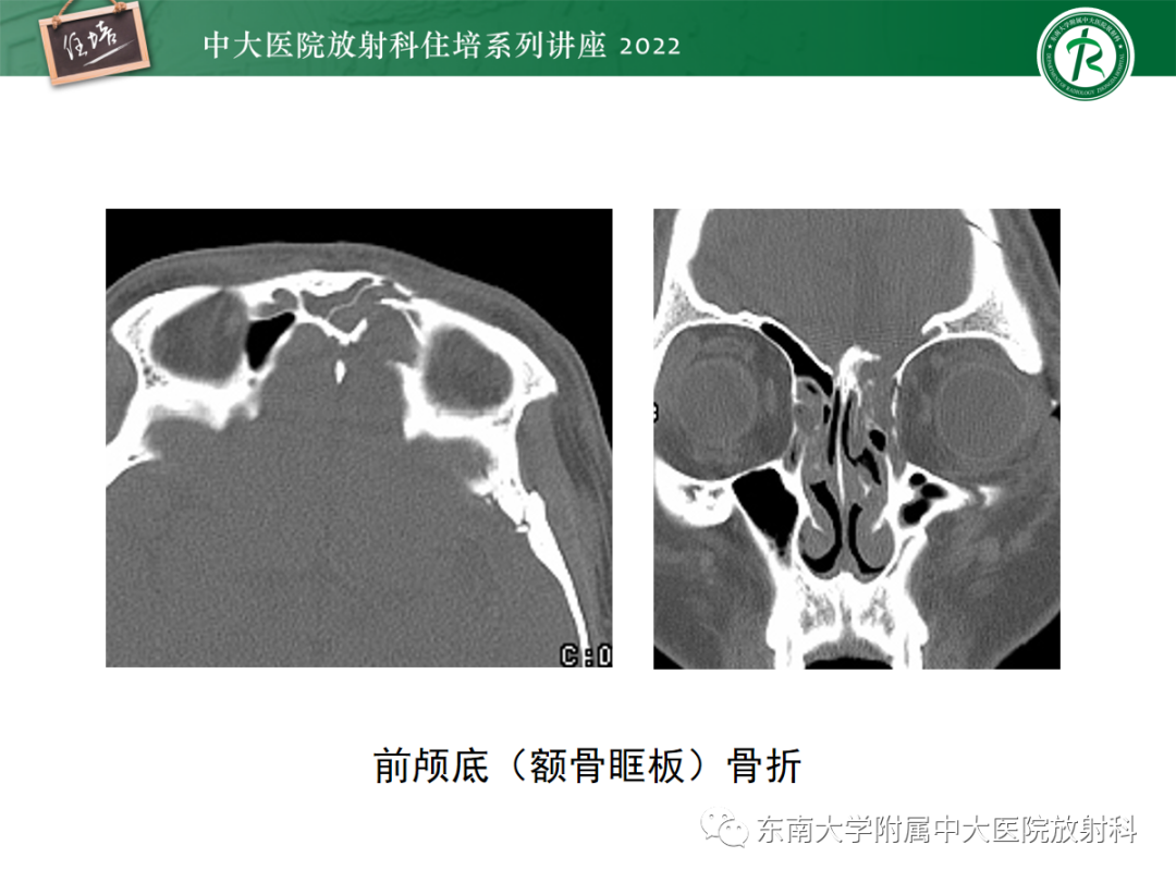 影像PPT - 【PPT】颌面部外伤的影像评估-65