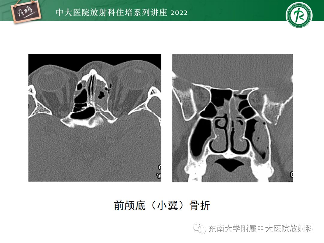 影像PPT - 【PPT】颌面部外伤的影像评估-66