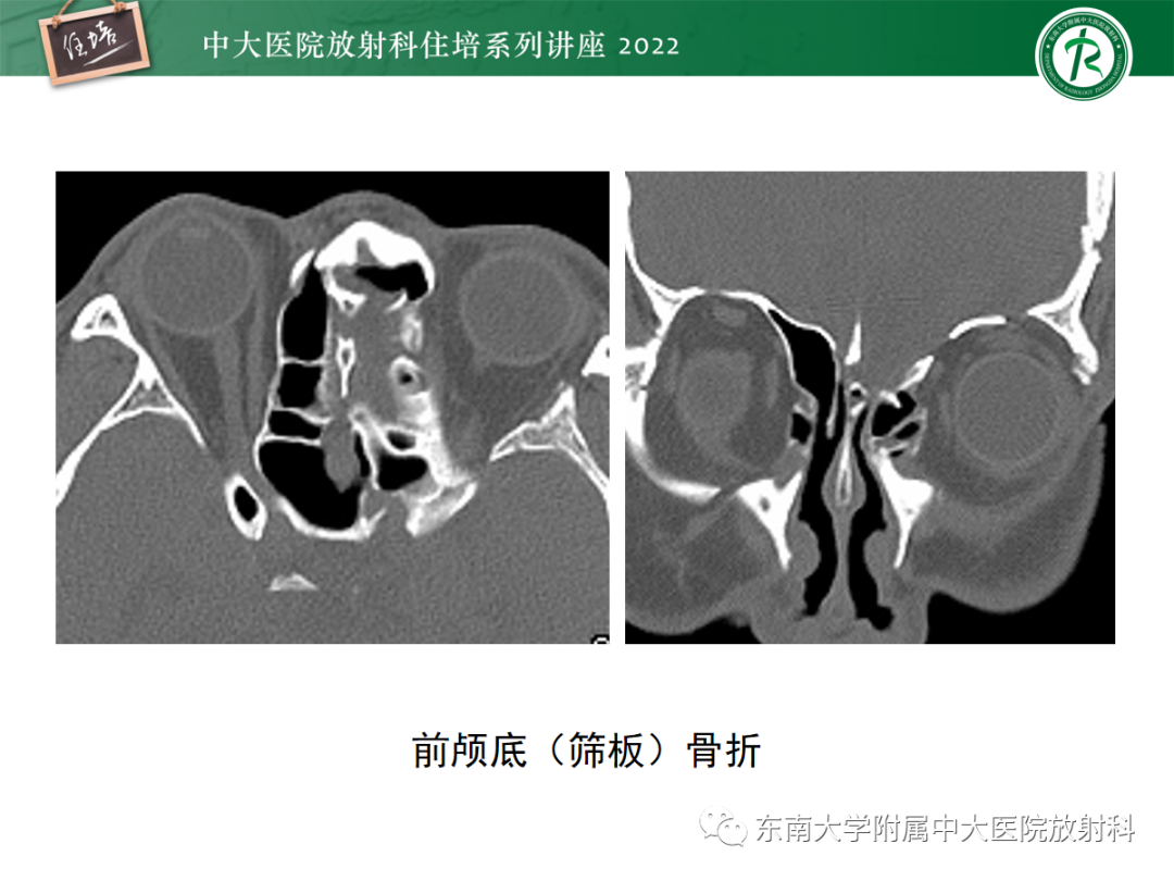 影像PPT - 【PPT】颌面部外伤的影像评估-67