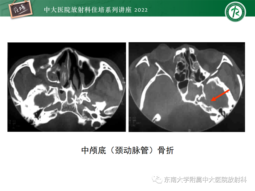 影像PPT - 【PPT】颌面部外伤的影像评估-69
