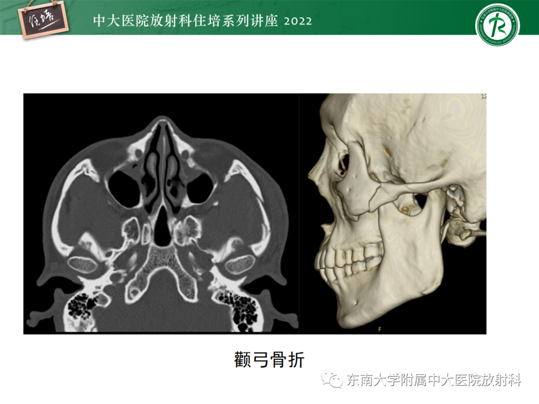 影像PPT - 【PPT】颌面部外伤的影像评估-74