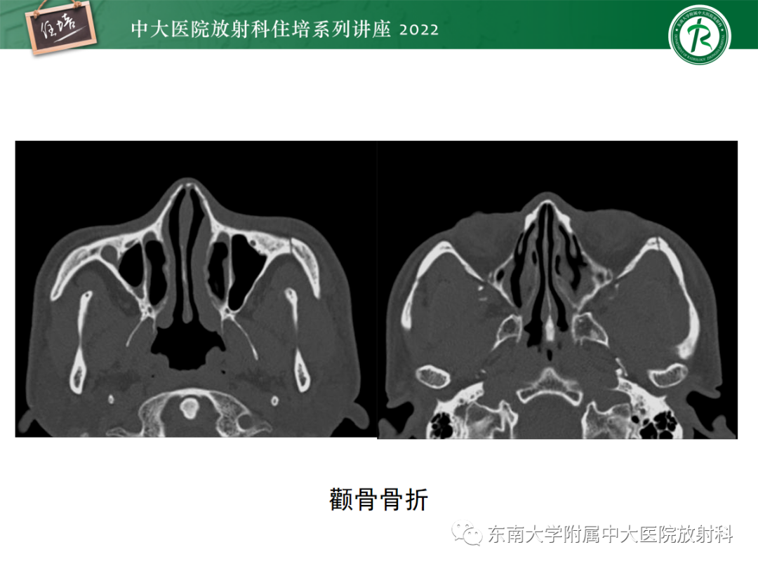 影像PPT - 【PPT】颌面部外伤的影像评估-73
