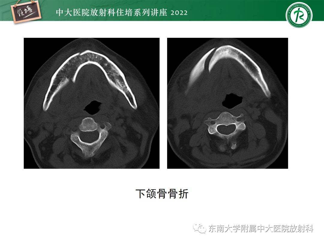 影像PPT - 【PPT】颌面部外伤的影像评估-76