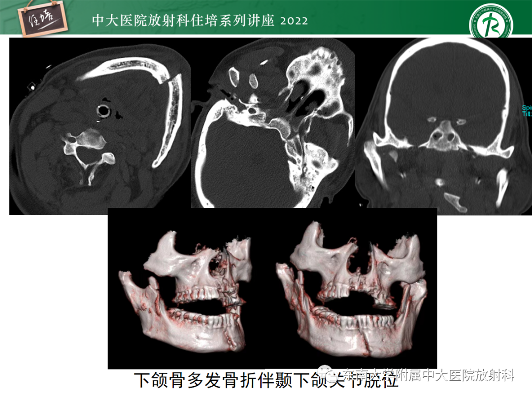 影像PPT - 【PPT】颌面部外伤的影像评估-77
