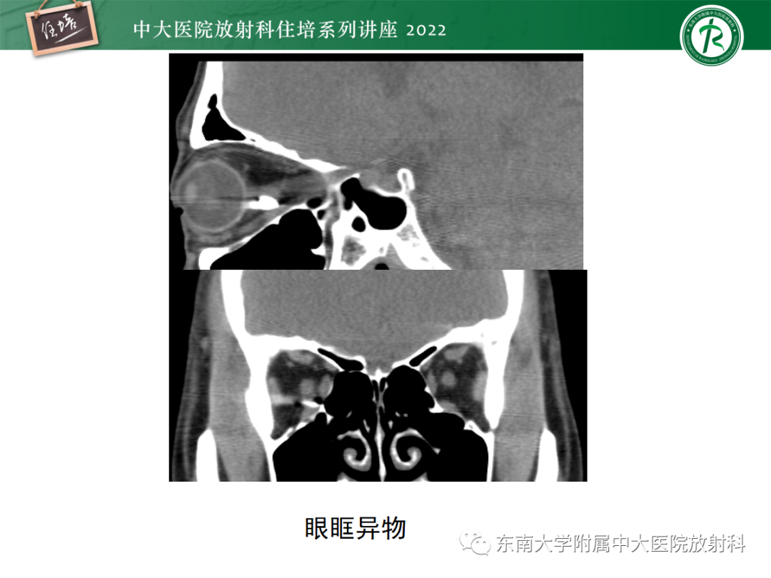 影像PPT - 【PPT】颌面部外伤的影像评估-80