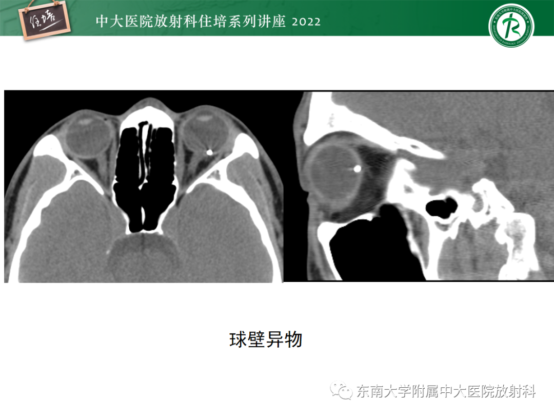 影像PPT - 【PPT】颌面部外伤的影像评估-81