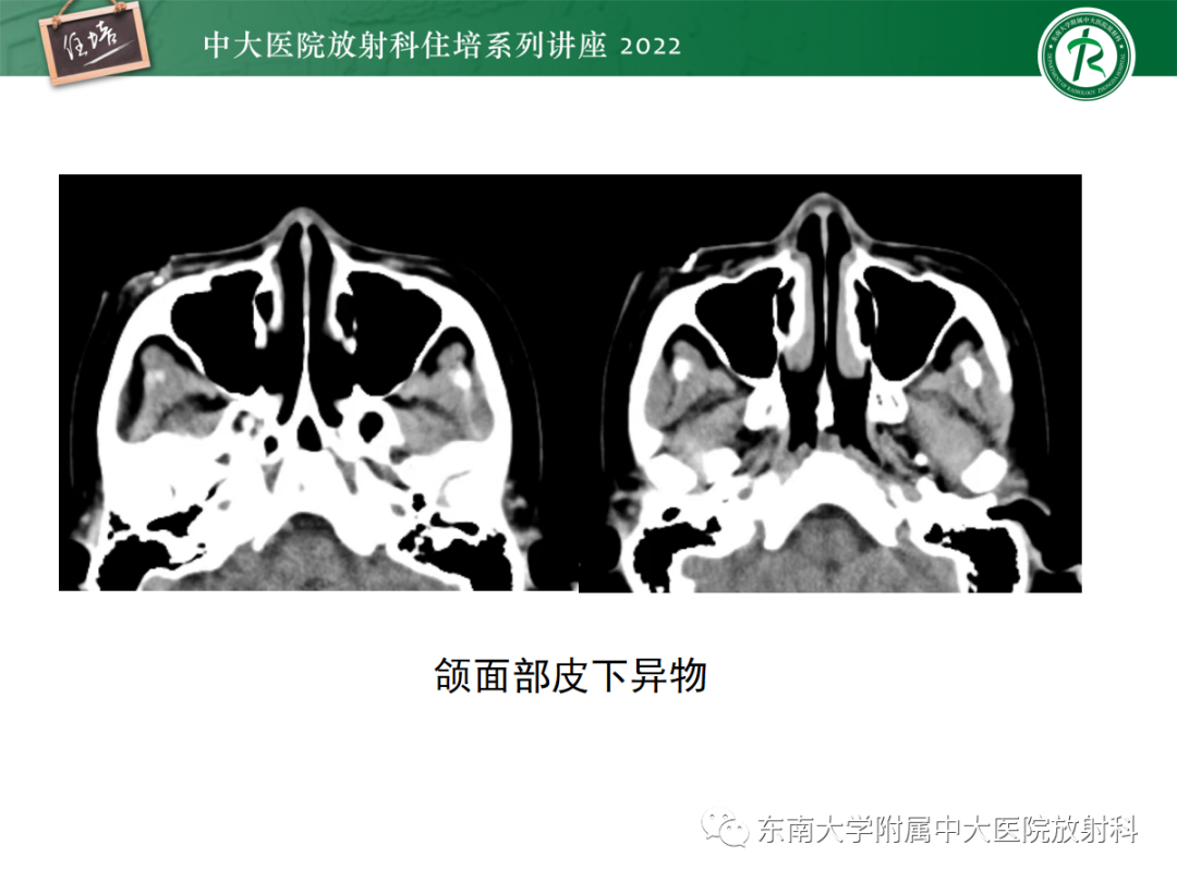 影像PPT - 【PPT】颌面部外伤的影像评估-82