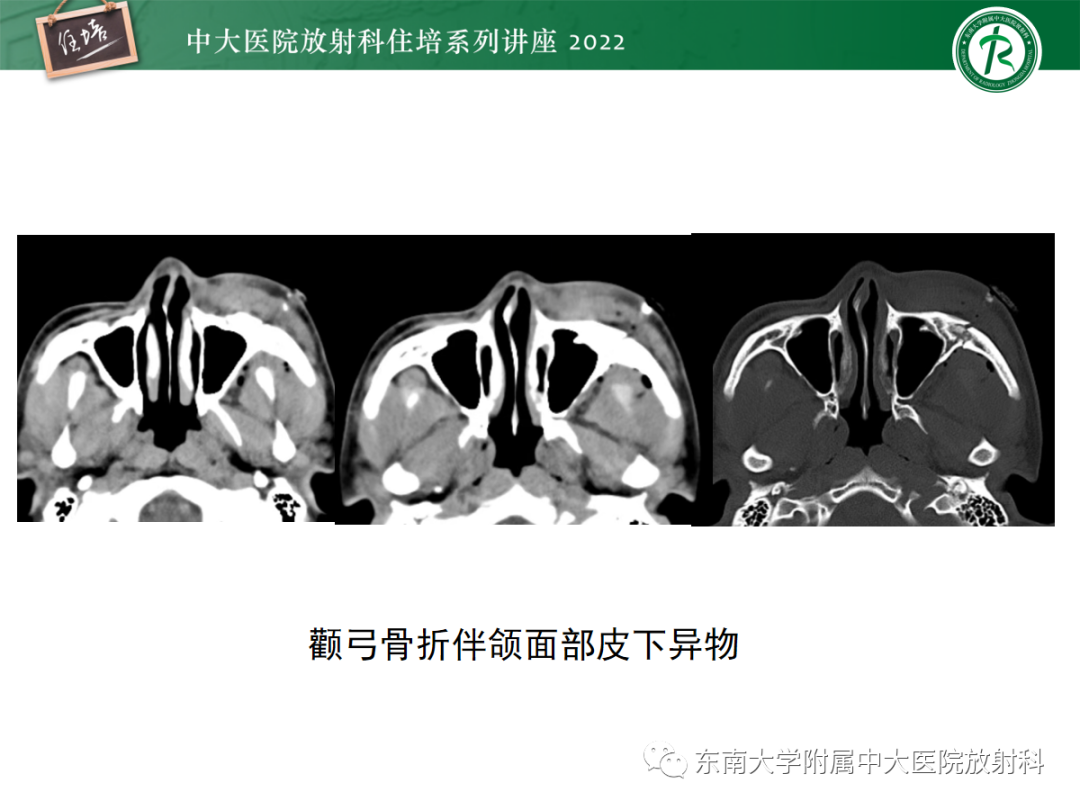 影像PPT - 【PPT】颌面部外伤的影像评估-83