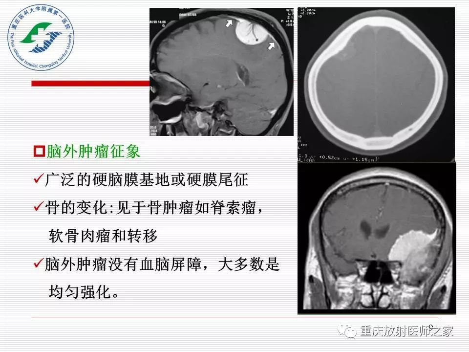 影像PPT - 【PPT】中枢神经系统肿瘤影像学诊断思路-9
