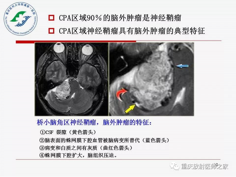 影像PPT - 【PPT】中枢神经系统肿瘤影像学诊断思路-10