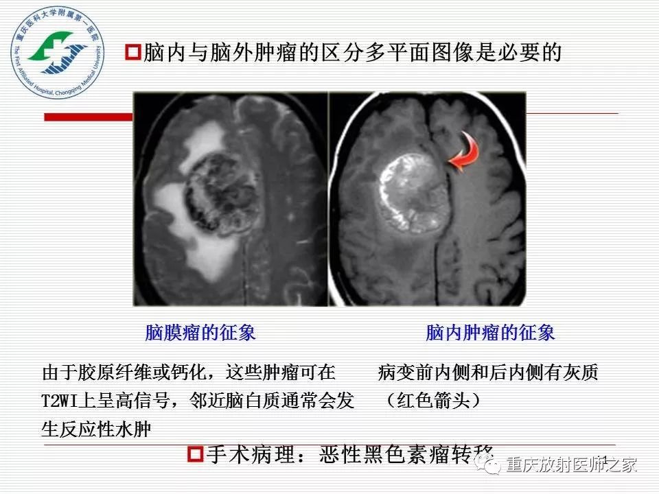影像PPT - 【PPT】中枢神经系统肿瘤影像学诊断思路-11