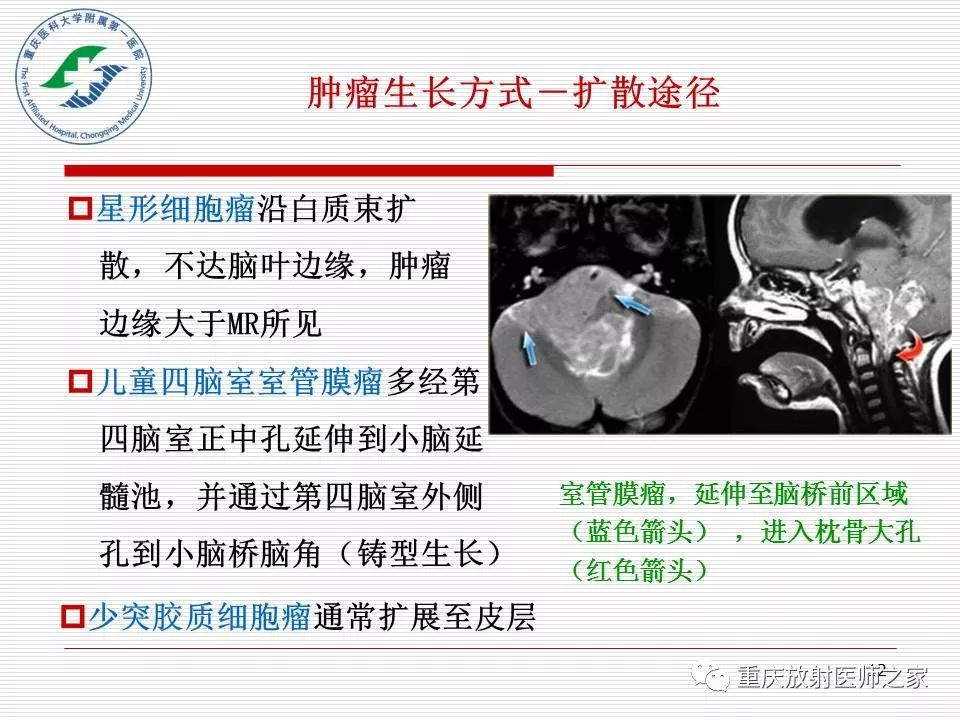 影像PPT - 【PPT】中枢神经系统肿瘤影像学诊断思路-12