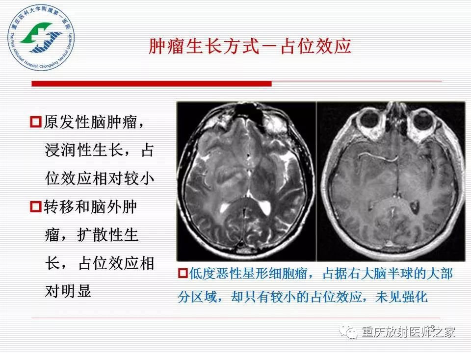 影像PPT - 【PPT】中枢神经系统肿瘤影像学诊断思路-13