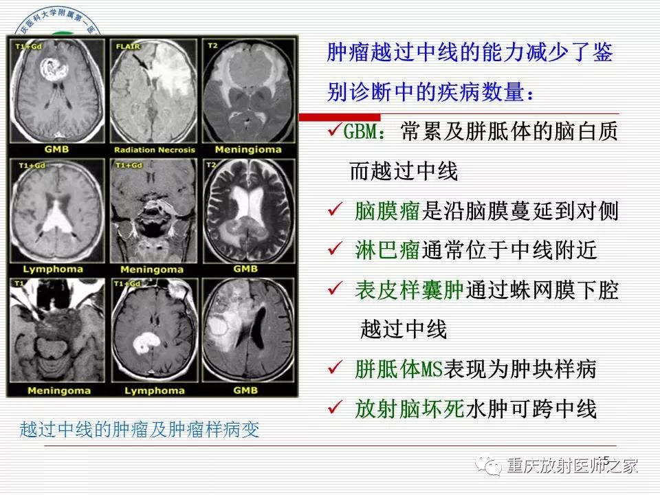 影像PPT - 【PPT】中枢神经系统肿瘤影像学诊断思路-15