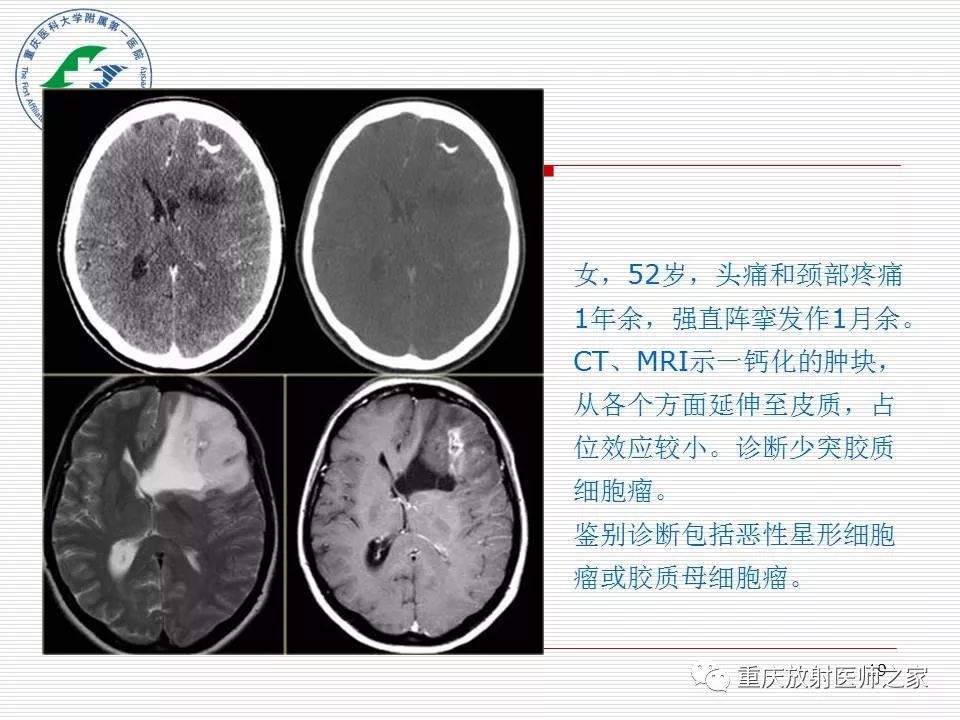 影像PPT - 【PPT】中枢神经系统肿瘤影像学诊断思路-19