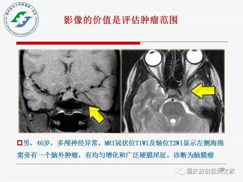 影像PPT - 【PPT】中枢神经系统肿瘤影像学诊断思路-20