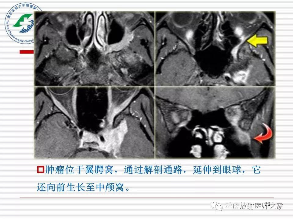 影像PPT - 【PPT】中枢神经系统肿瘤影像学诊断思路-21