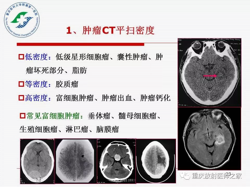 影像PPT - 【PPT】中枢神经系统肿瘤影像学诊断思路-23