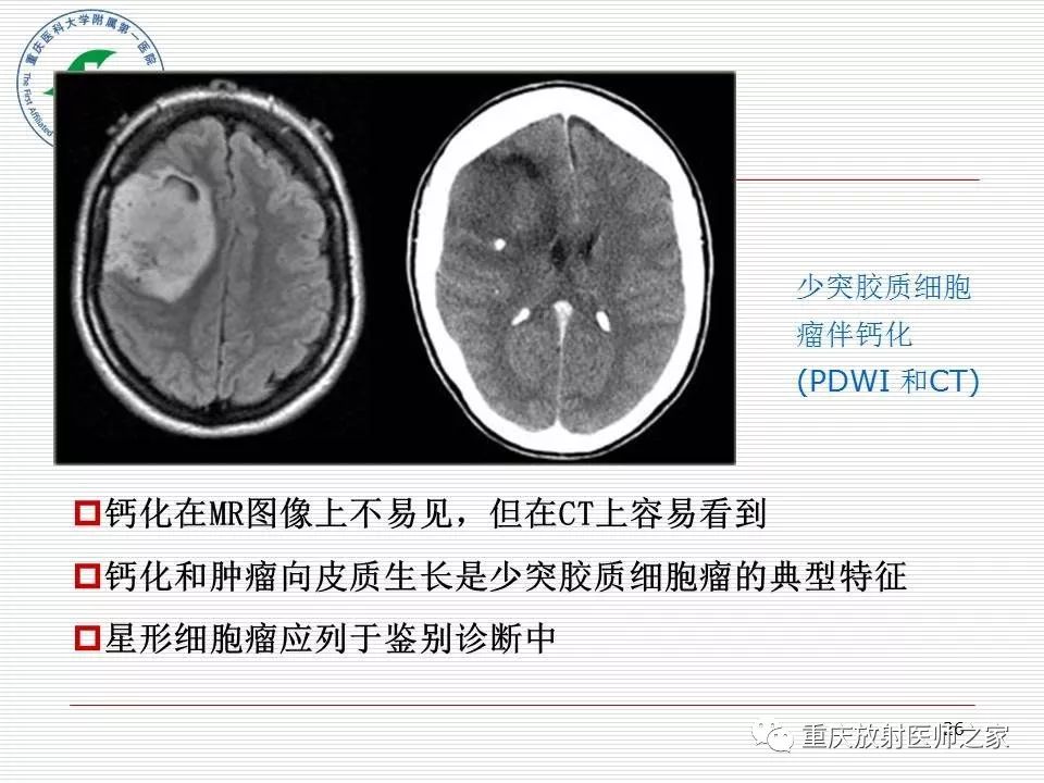影像PPT - 【PPT】中枢神经系统肿瘤影像学诊断思路-26