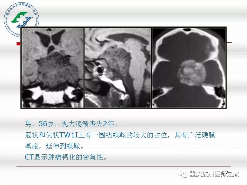 影像PPT - 【PPT】中枢神经系统肿瘤影像学诊断思路-27