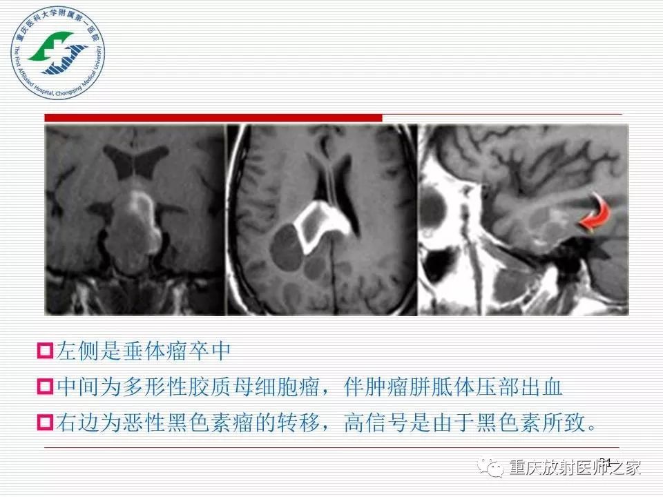 影像PPT - 【PPT】中枢神经系统肿瘤影像学诊断思路-31